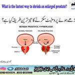 What is the fastest way to shrink an enlarged prostate?