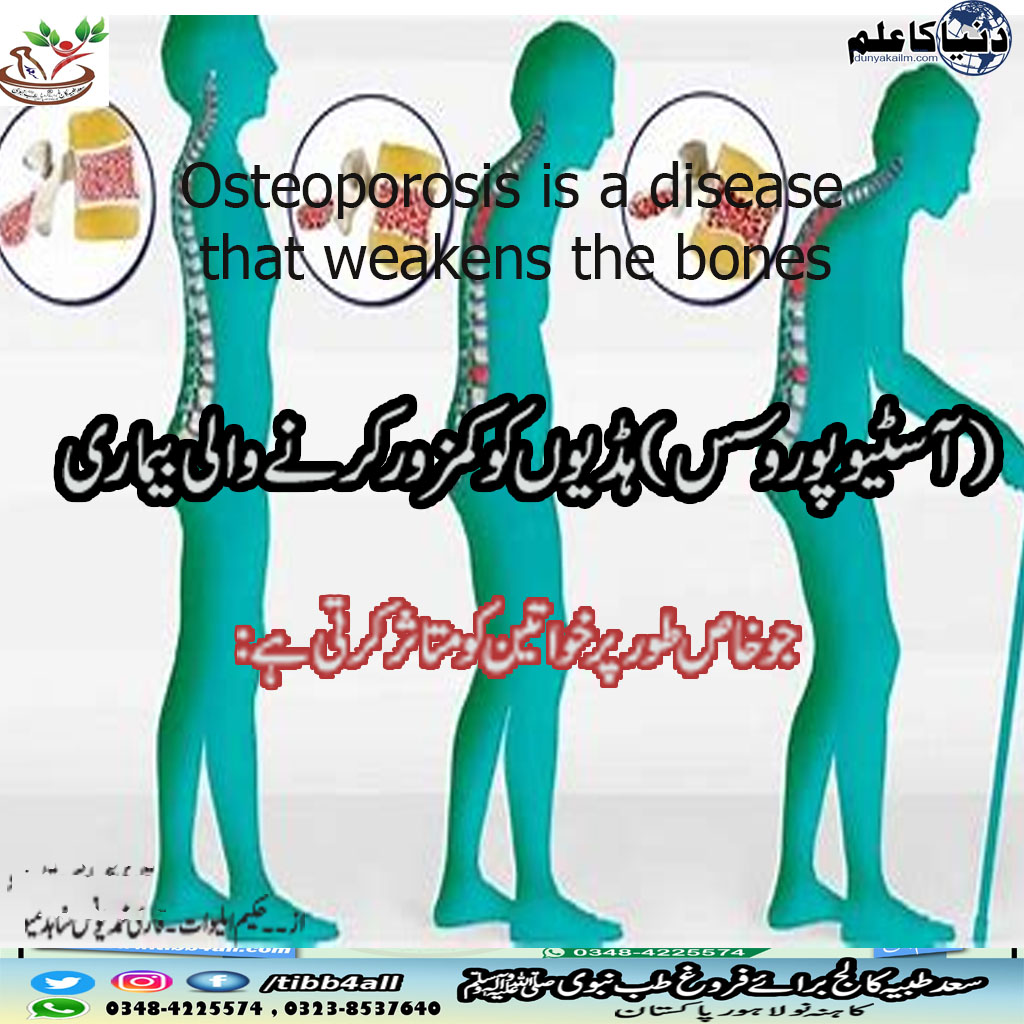 Read more about the article Osteoporosis is a disease that weakens the bones